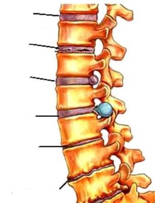osteocondritis an spine