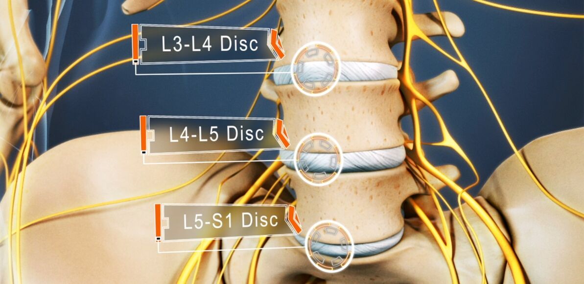 Dioscaí den spine lumbar, is minice a mbíonn tionchar orthu in osteochondrosis