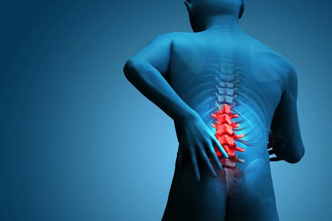 Is é an príomh-symptom osteochondrosis an spine lumbar pian sa chúl níos ísle. 