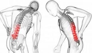 Hernia Interveirteabrach - casta le osteochondrosis