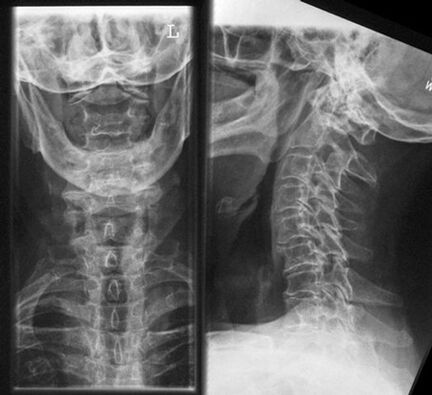 X -ray ceirbheacs - Modh diagnóise osteochondrosis