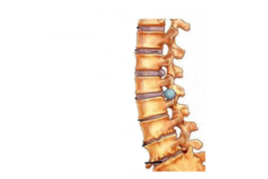 Damáiste don dromlach le osteochondrosis ceirbheacs