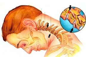 Pinching an néaróg sa dromlach le osteochondrosis ceirbheacs