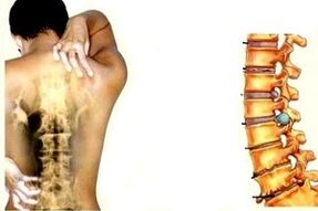 Péine ar ais ag céimeanna éagsúla d'fhorbairt osteochondrosis ceirbheacs