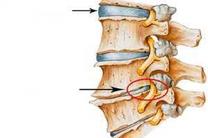 Spine gnáth agus damáistithe le osteochondrosis ceirbheacs