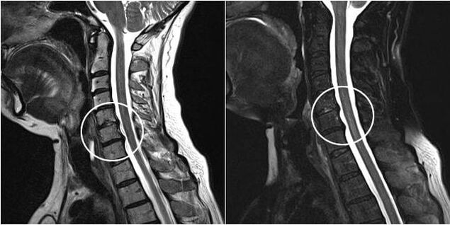 MRI an spine cheirbheacsach