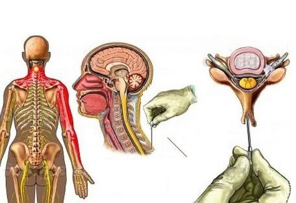 cóireáil osteochondrosis ceirbheacsach le acupuncture