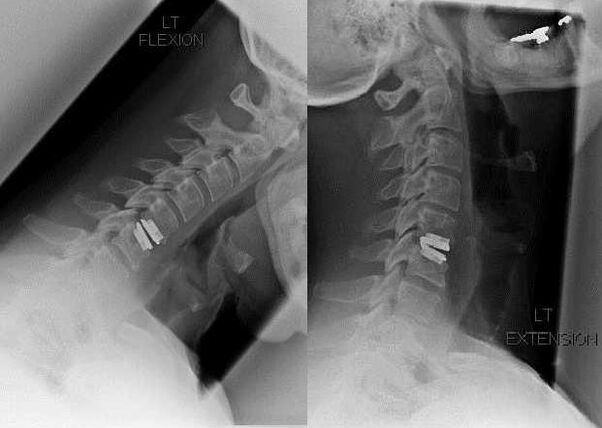 íomhá an spine tar éis obráid