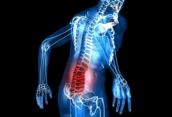 cad é osteochondrosis lumbar