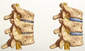 cén chuma atá ar osteochondrosis