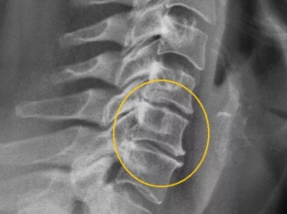 Osteochondrosis den spine ceirbheacsach ar x-gha
